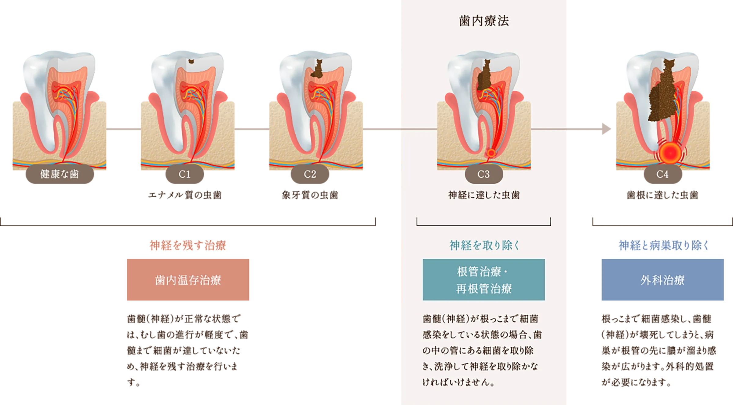 歯内治療