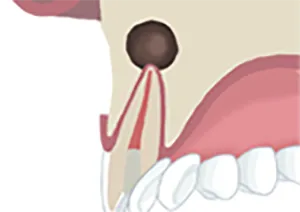 切開