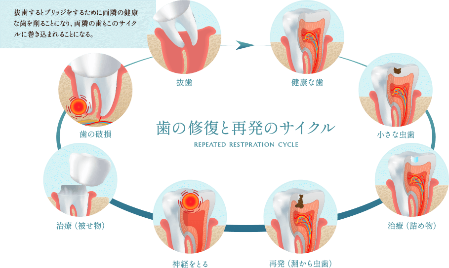 歯の修復と再発のサイクル
