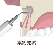 炎症の除去