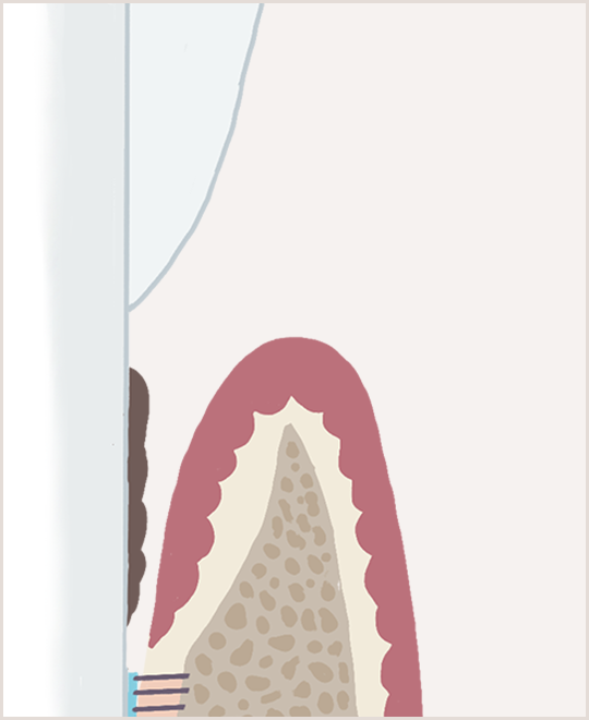 歯周組織再生治療イメージ1