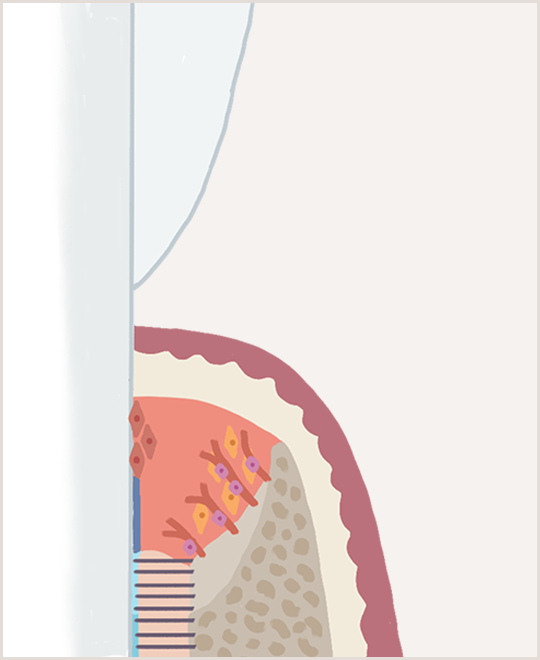 歯周組織再生治療イメージ3
