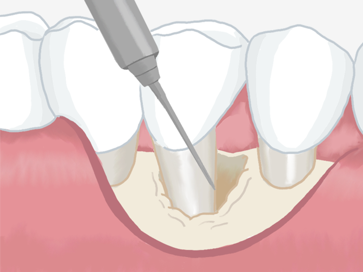 歯周形成外科イメージ