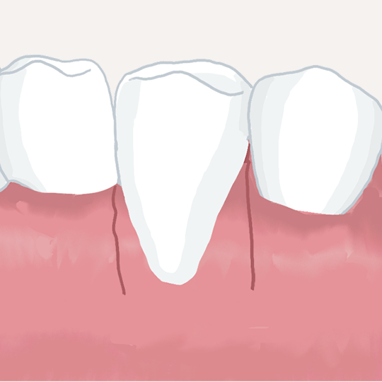 歯周形成外科イメージ