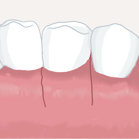 歯周形成外科イメージ
