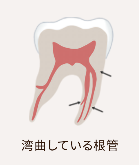 湾曲している根管