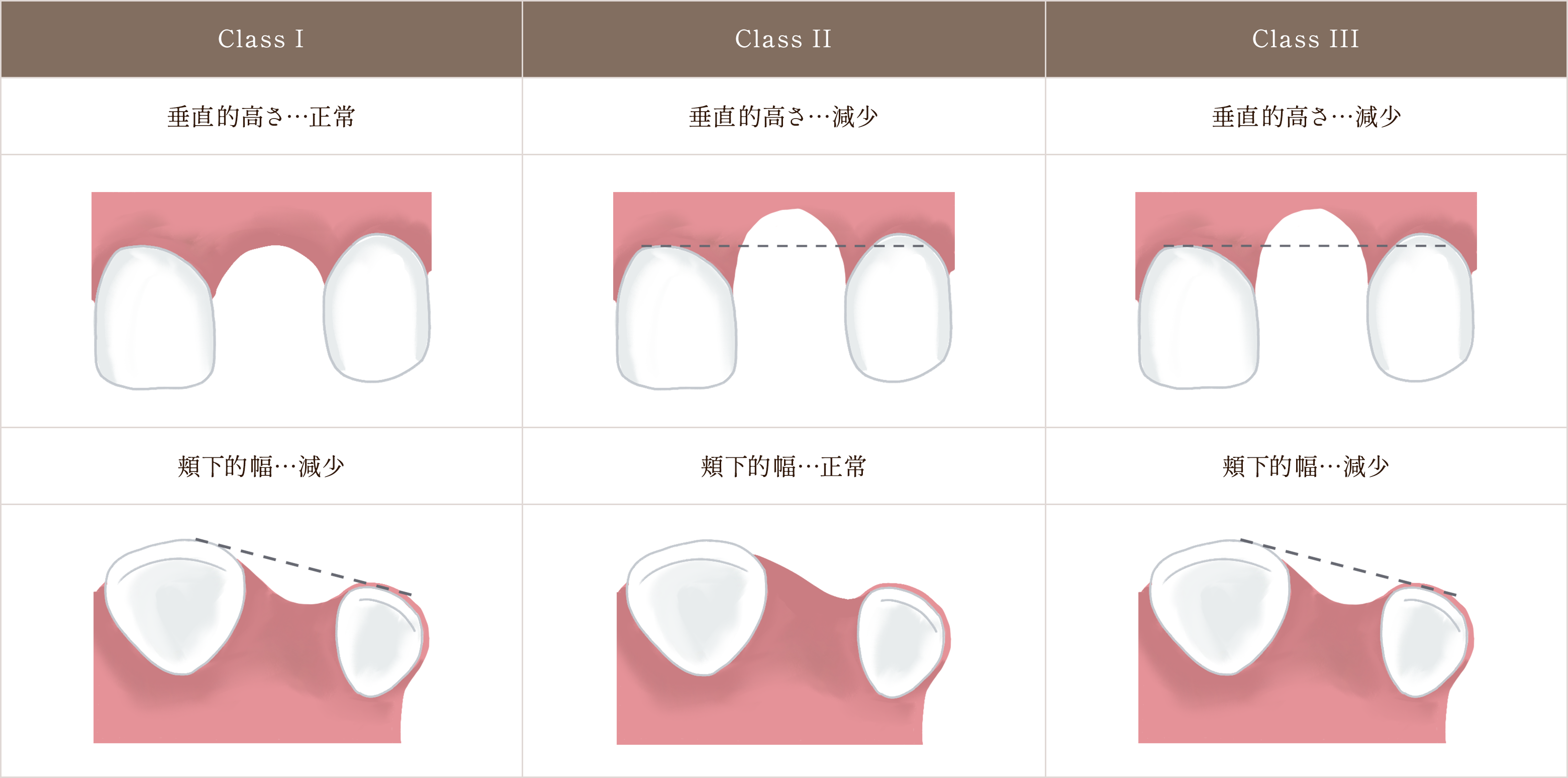 歯槽堤増大術 判断基準