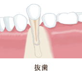 歯根の切断
