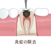 薬剤充填