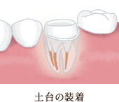 骨の削除