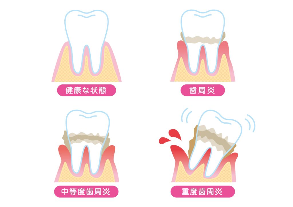 慢性歯周炎