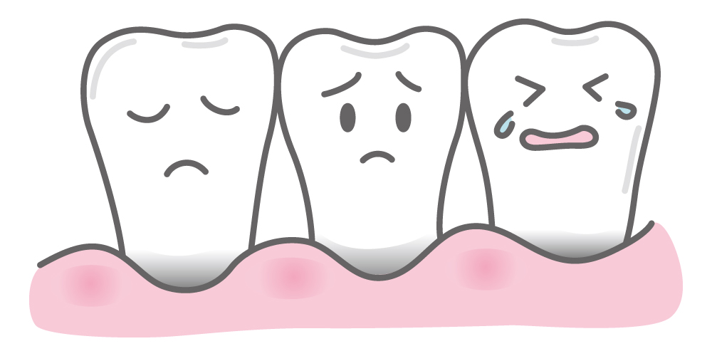 歯茎の退縮
