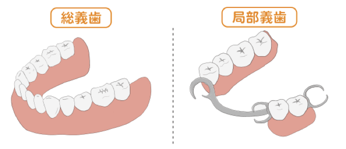 総義歯と局部義歯